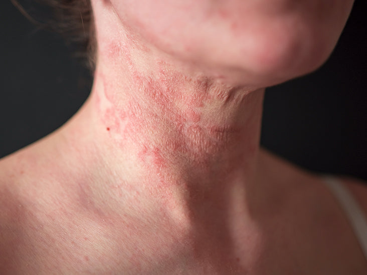 What is Eczema?