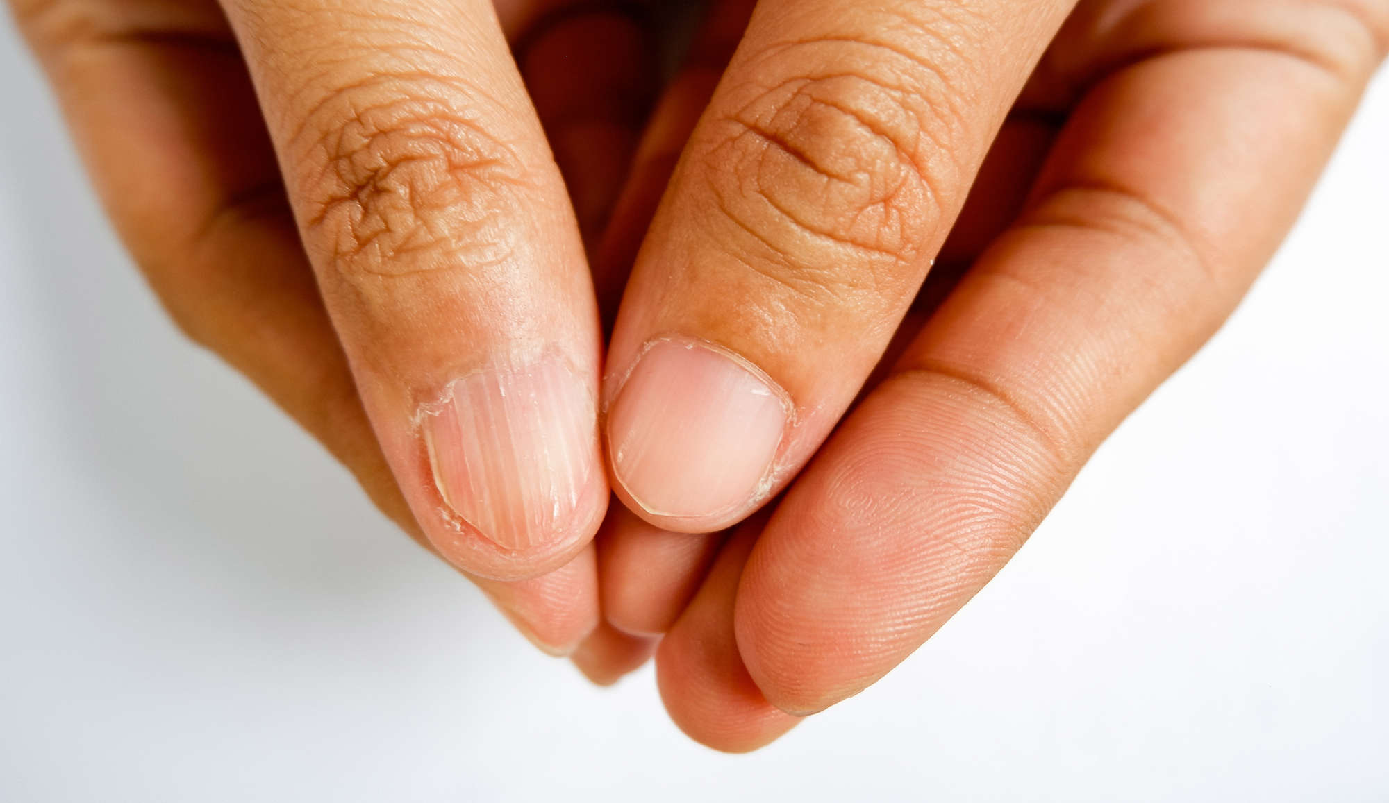 Nail Infections