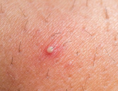What are ingrown hairs?